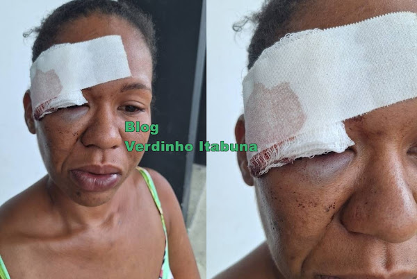 JOVEM DE 23 ANOS É BRUTALMENTE AGREDIDA POR VIZINHO EM ILHÉUS E CORRE RISCO DE PERDER A VISÃO